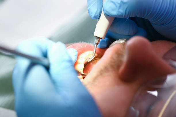 Best Emergency Tooth Extraction in Yosemite Valley, CA